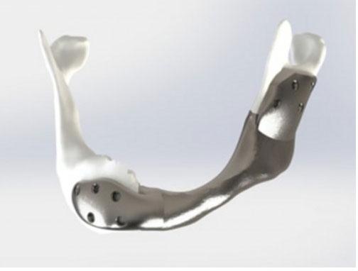 3D printing titanium jaw